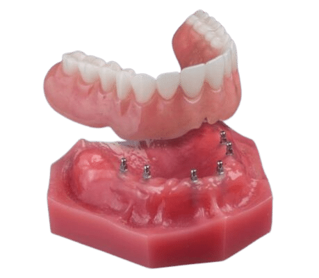 Dentures in Salt Lake City, UT | Dr. Ruedi Tillmann