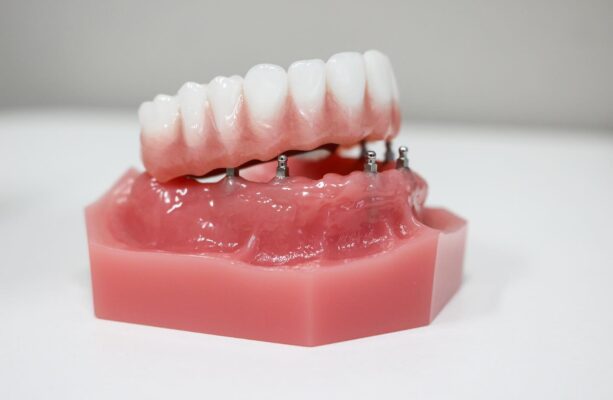 Loose Dentures in Kaysville, UT | Book a Free Consultation Today